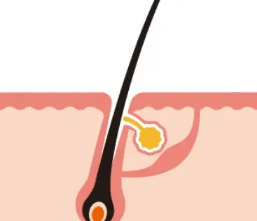 Chute de cheveux : comprendre le cycle pilaire et les solutions naturelles efficaces 5 chute de poil LARA SENSE