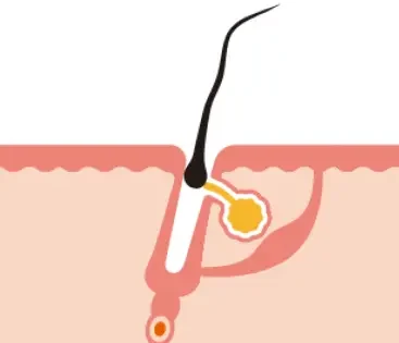Chute de cheveux : comprendre le cycle pilaire et les solutions naturelles efficaces 7 chute de poil LARA SENSE